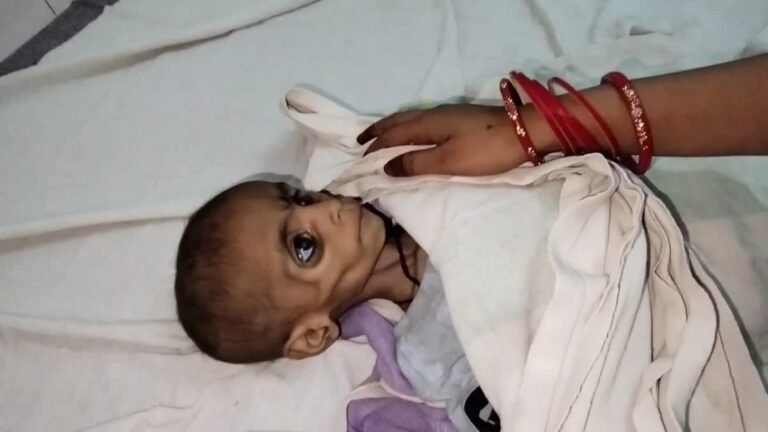 शिवपुरी : इसे मर जाने दो यह जीकर क्या करेगी?, कुपोषण से शिवपुरी में लड़की की मौत